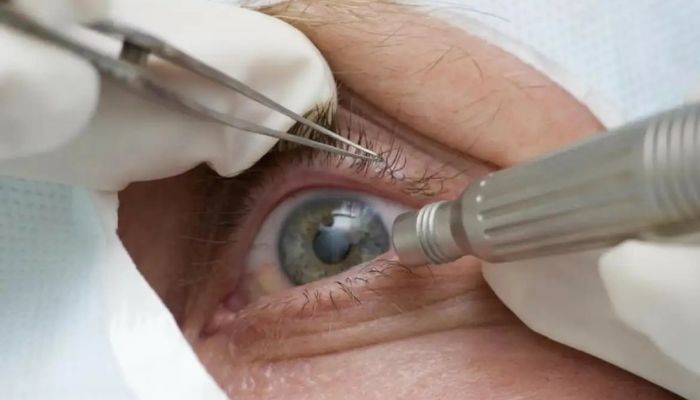  Cirurgia que altera cor do olho tem uso restrito para pessoas cegas 